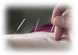 photo of acupuncture needles